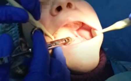Tooth Extraction After Delivery