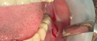Treatment and prevention of pus in gums