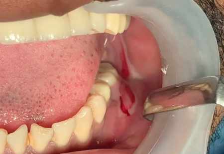 Treatment and prevention of pus in gums