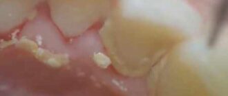Plaque on lower teeth and gums