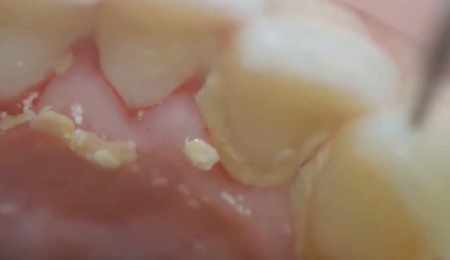 Plaque on lower teeth and gums