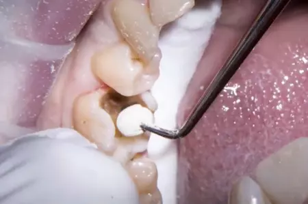 Dentist puts a filling in a tooth cleaned of decay