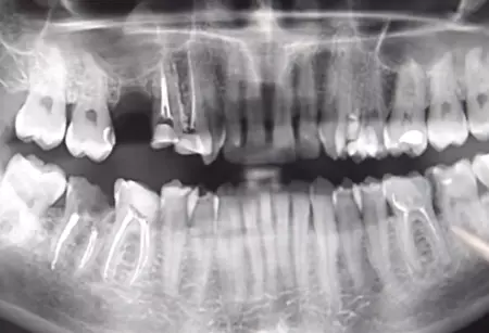 X-rays can show how badly a tooth is affected by decay