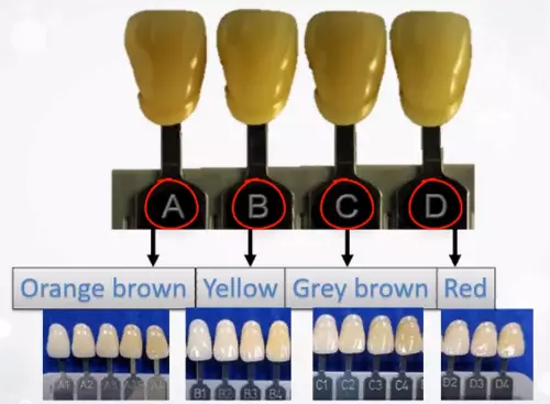 Scale of tooth darkening depending on the natural color of the patient's teeth