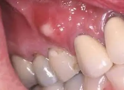 white hard bump on gums