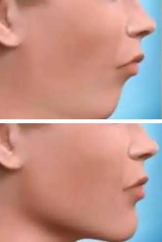 Orthognathic Surgery (Jaw Surgery) requires