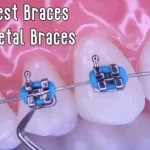 Cheapest braces