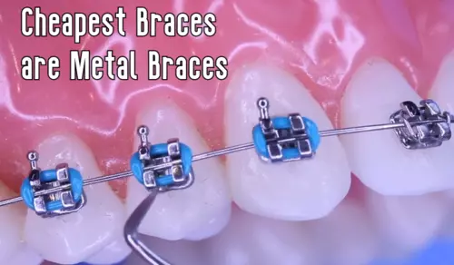 Cheapest braces