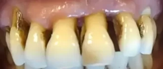 Teeth Start to Fail