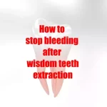 How to stop bleeding after wisdom teeth extraction