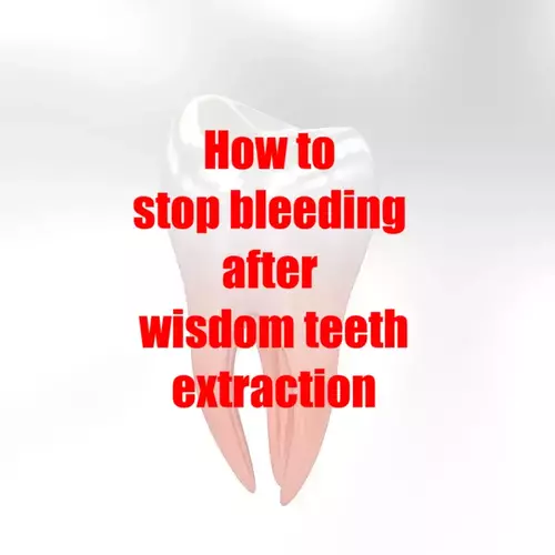 How to stop bleeding after wisdom teeth extraction