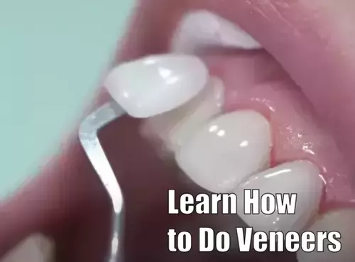 Learn How to Do Veneers: What Courses to Take and What Diploma You Need