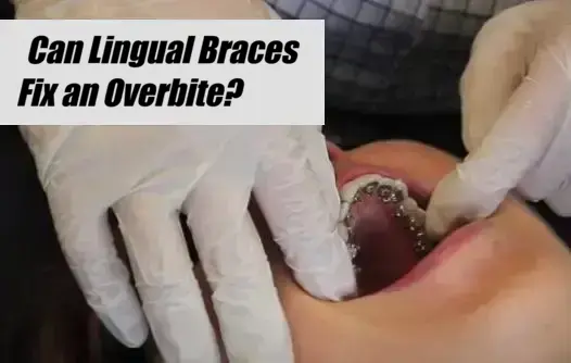 Can Lingual Braces Fix an Overbite?