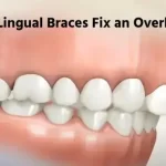 Lingual Braces: An Effective Solution for Overbites