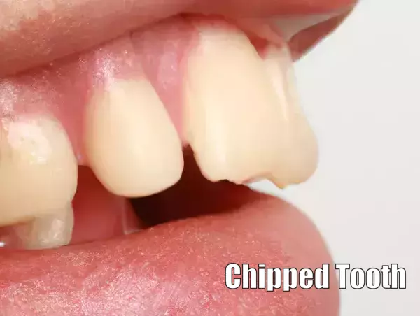 Chipped, Fractured or Broken Teeth