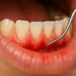 Close-up of inflamed gums after pregnancy with dental probe examining bleeding area during postpartum gingivitis check