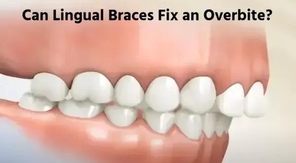 Lingual Braces: An Effective Solution for Overbites