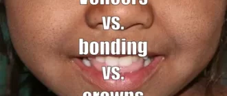 Veneers vs. bonding vs. crowns