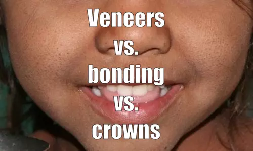 Veneers vs. bonding vs. crowns