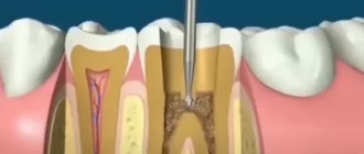 Pain When Biting After a Root Canal