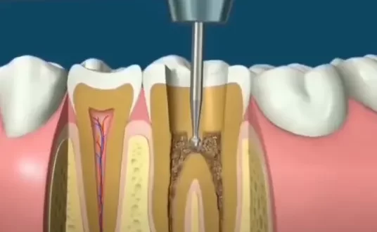 Pain When Biting After a Root Canal