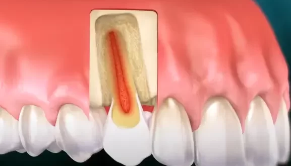 Endodontic Procedure