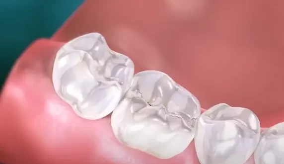 Bump on Gum Below Broken Tooth