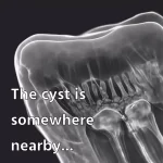 The Cyst Near a Tooth Root