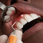Close-up dental examination showing a small painless bump on gums above the upper canine, with dental mirror and probe, healthy teeth and naturally red gums.