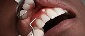 Close-up dental examination showing a small painless bump on gums above the upper canine, with dental mirror and probe, healthy teeth and naturally red gums.