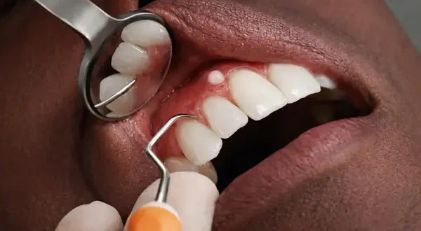 Close-up dental examination showing a small painless bump on gums above the upper canine, with dental mirror and probe, healthy teeth and naturally red gums.
